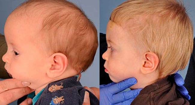 Virtual tools help surgeons correct skull defects in babies